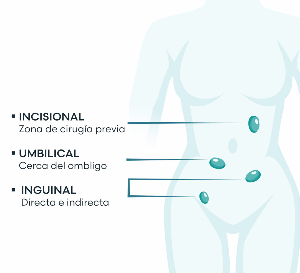 Anatomía hernias