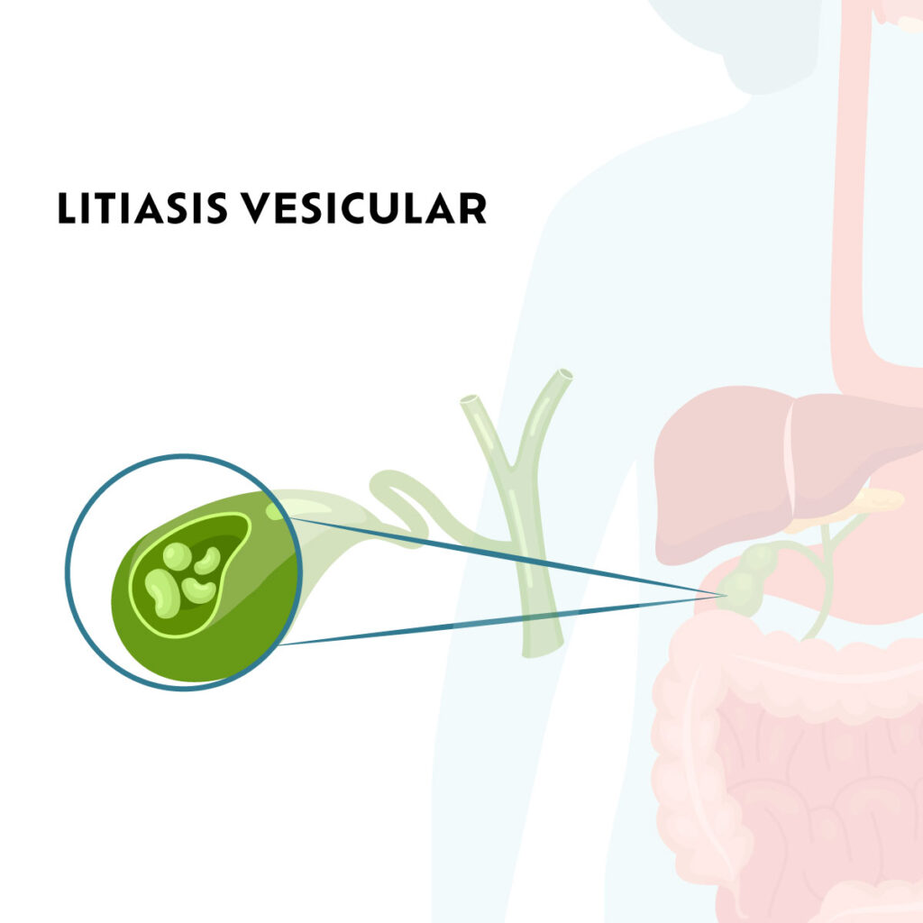 litiasis vesicular