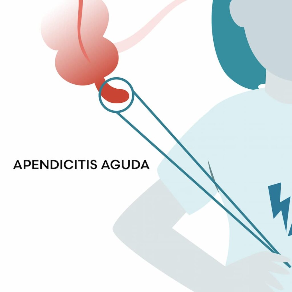 Apendicitis Aguda